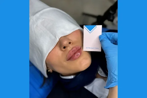 استفاده از فیلر لب چه تاثیری در زیبایی صورت دارد؟