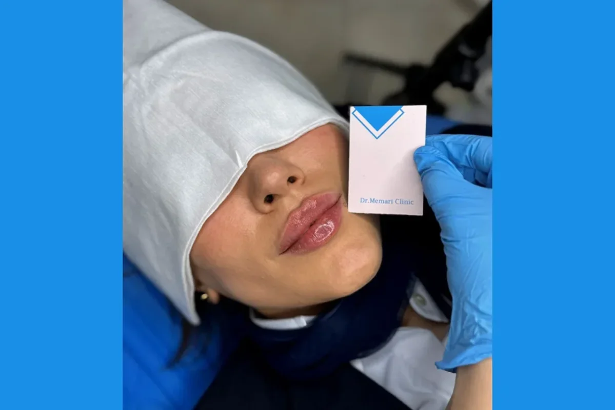 استفاده از فیلر لب چه تاثیری در زیبایی صورت دارد؟